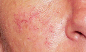 skin tag removal in Glasgow