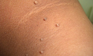 skin tag removal in Glasgow