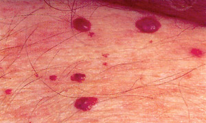 skin tag removal in Glasgow